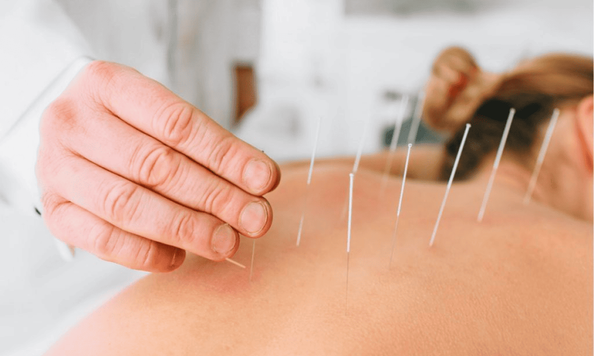 Dry Needling